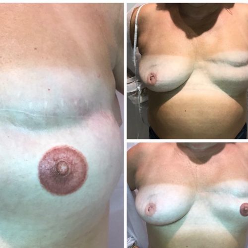 3D areola før og efter J