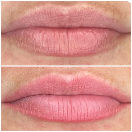 soft lips før-efter2